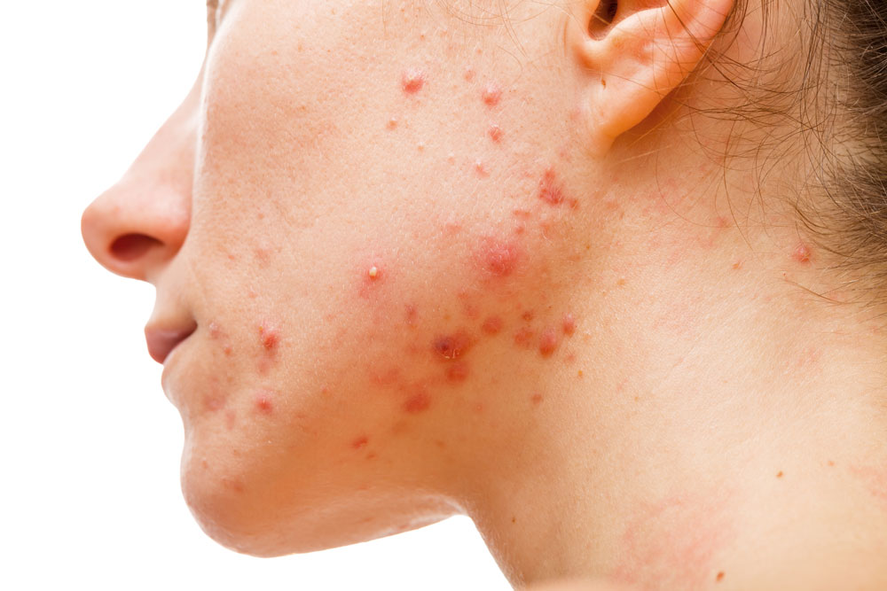 Acne e Rosácea
