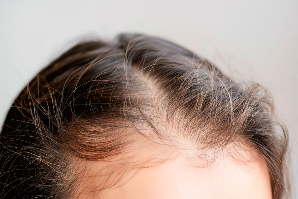 Doenças Do Cabelo E Unhas Doenças do cabelo e unhas